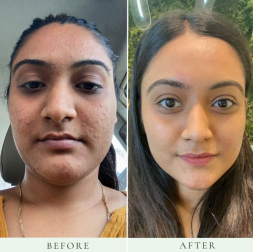 Acne treatment in mangalore