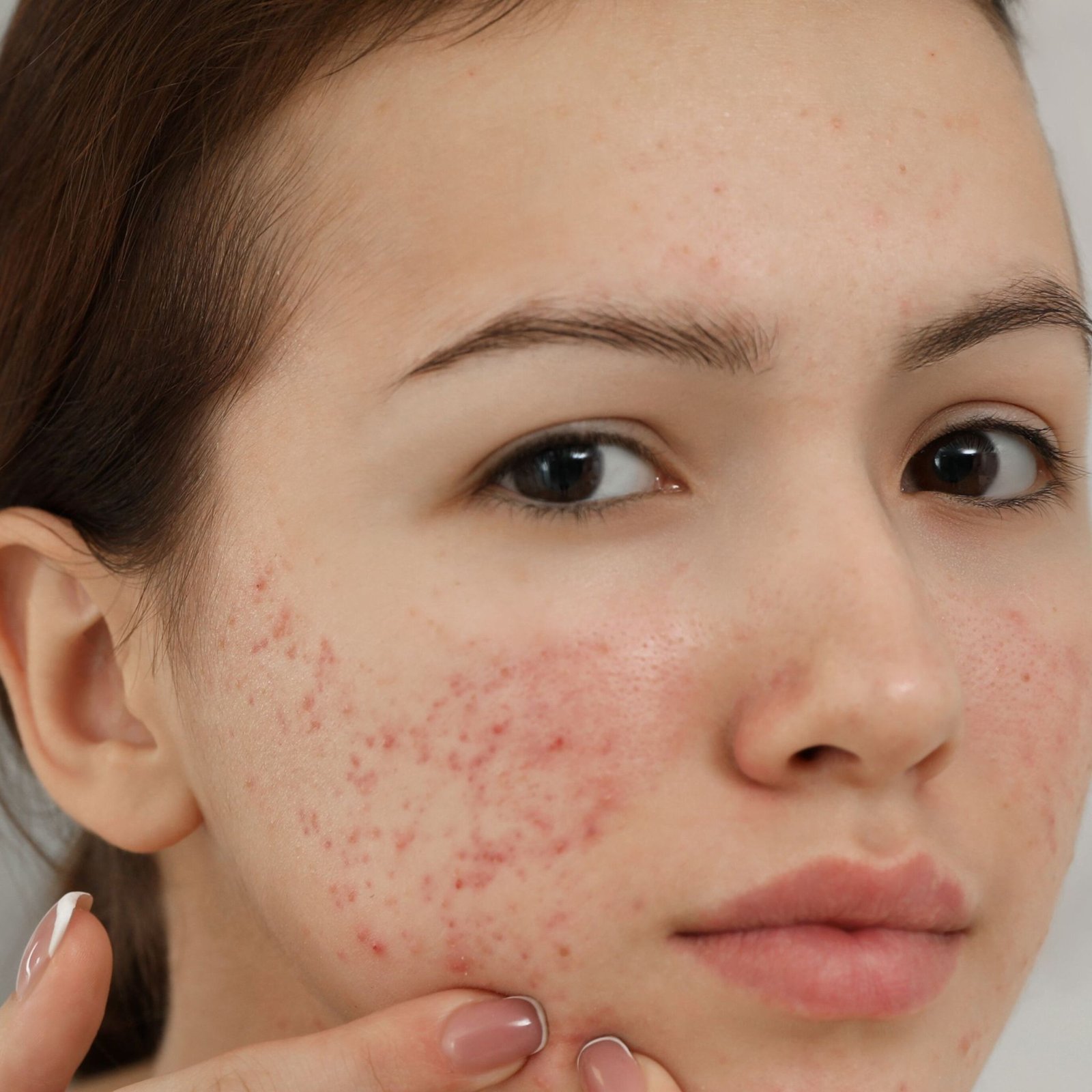 Acne Prone